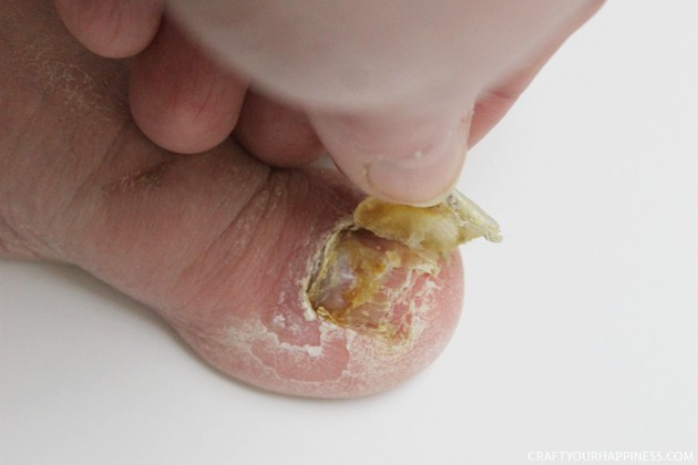 Get rid of icky toenail fungus with our one ingredient toenail fungus cure! We've got a bonus free sachet pattern you can make to keep your shoes fresh.
